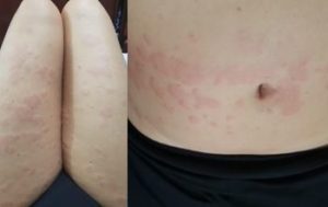 Leia mais sobre o artigo Andrea Rodrigues Corrêa – Urticária